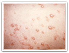 Shingles rash